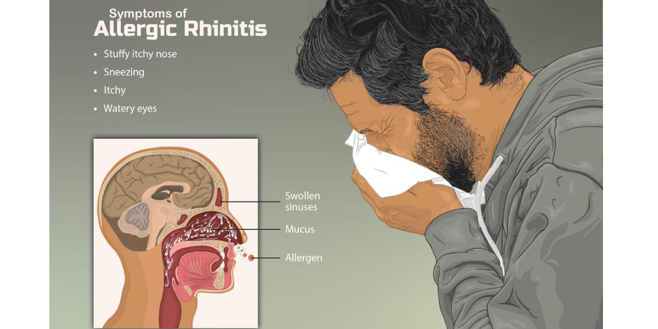 Typical Symptoms of Allergic Rhinitis